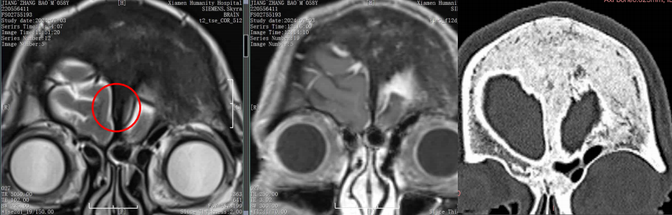 術前MRI.png
